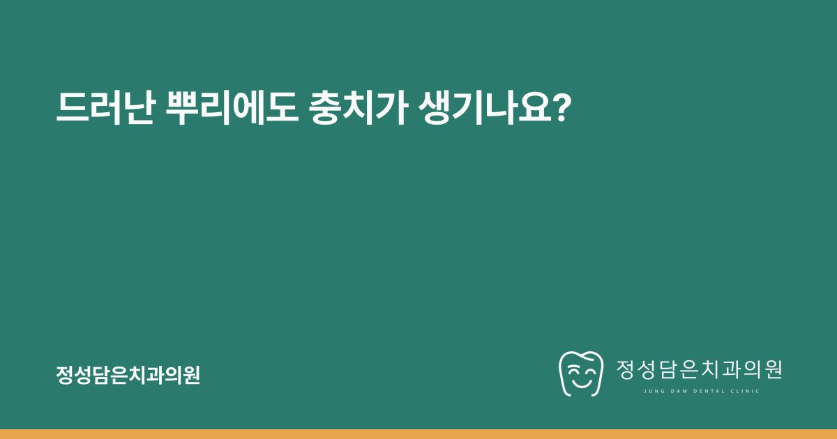 드러난 뿌리에도 충치가 생기나요?