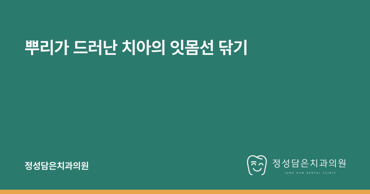 뿌리가 드러난 치아의 잇몸선 닦기