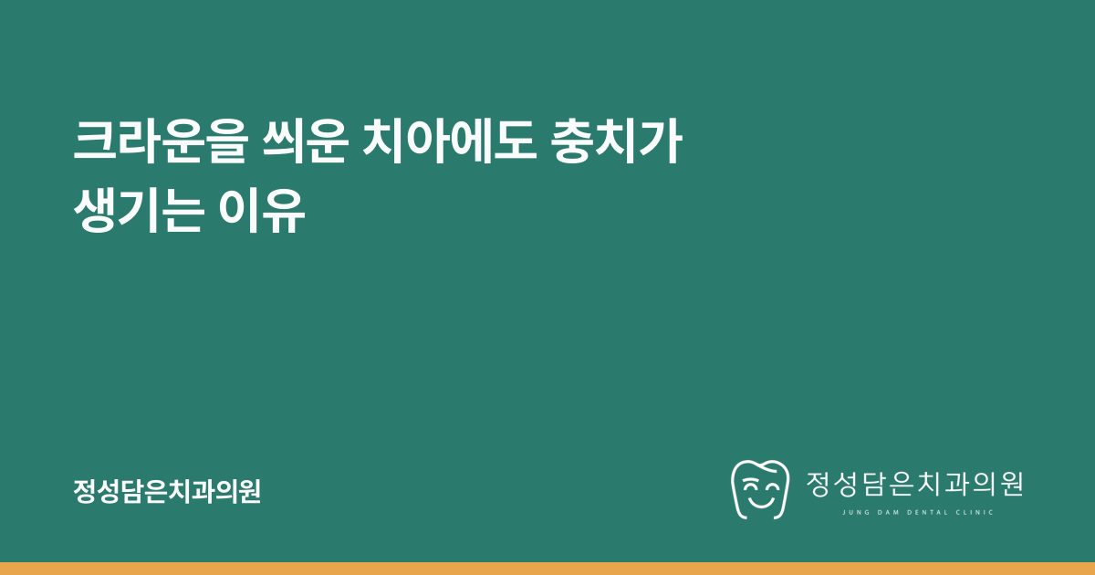 크라운을 씌운 치아에도 충치가 생기는 이유