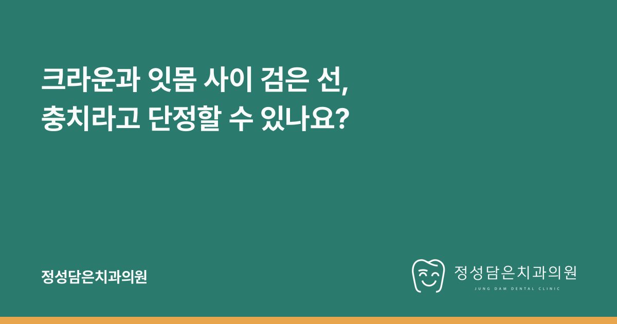 크라운과 잇몸 사이 검은 선, 충치라고 단정할 수 있나요?