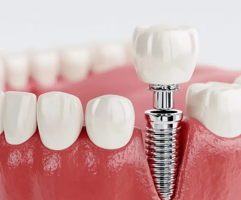 임플란트 구조 모형