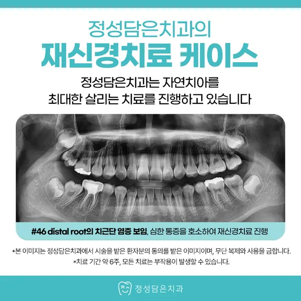 부평재신경치료, 치료 받았던 치아가 다시 아프다면 바로 뽑아야 할까?