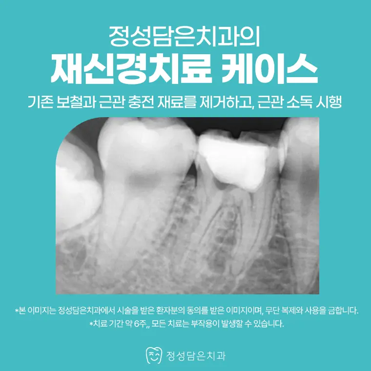 정성담은치과 재신경치료 케이스
