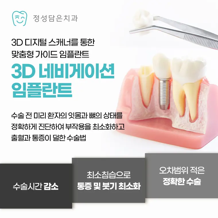 정성담은치과 3d 네비게이션 임플란트
