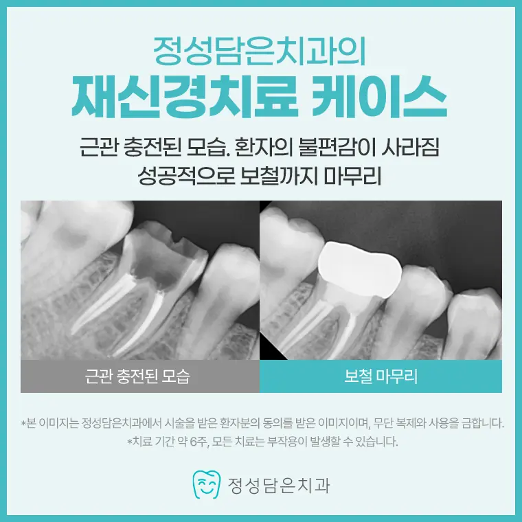 정성담은치과 재신경치료 케이스