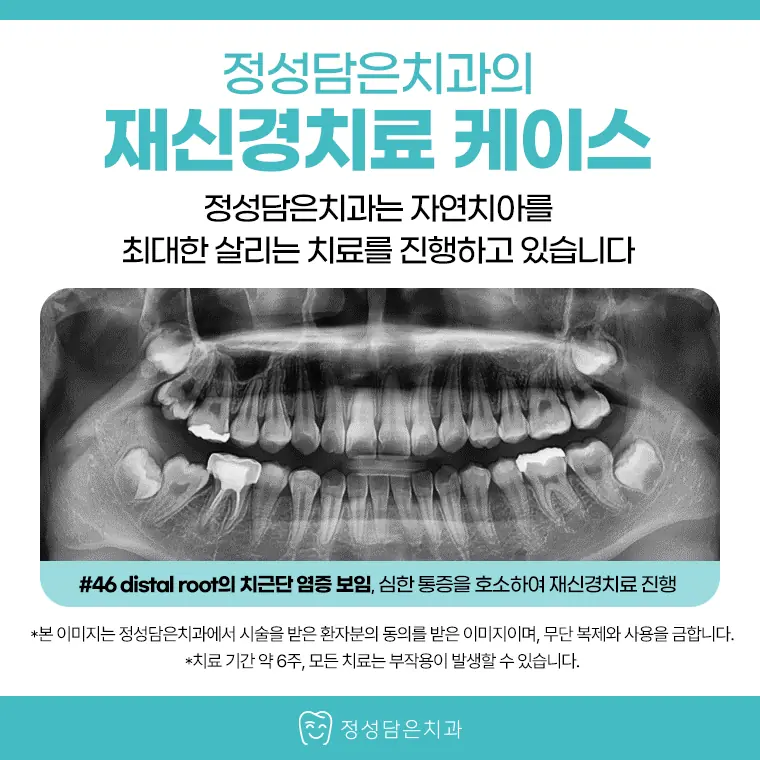 정성담은치과 재신경치료 케이스
