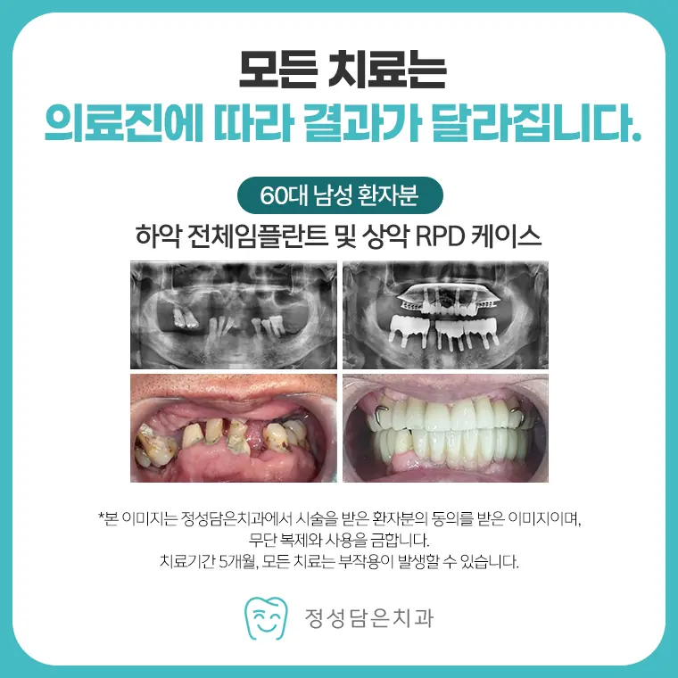 정성담은치과 임플란트 케이스