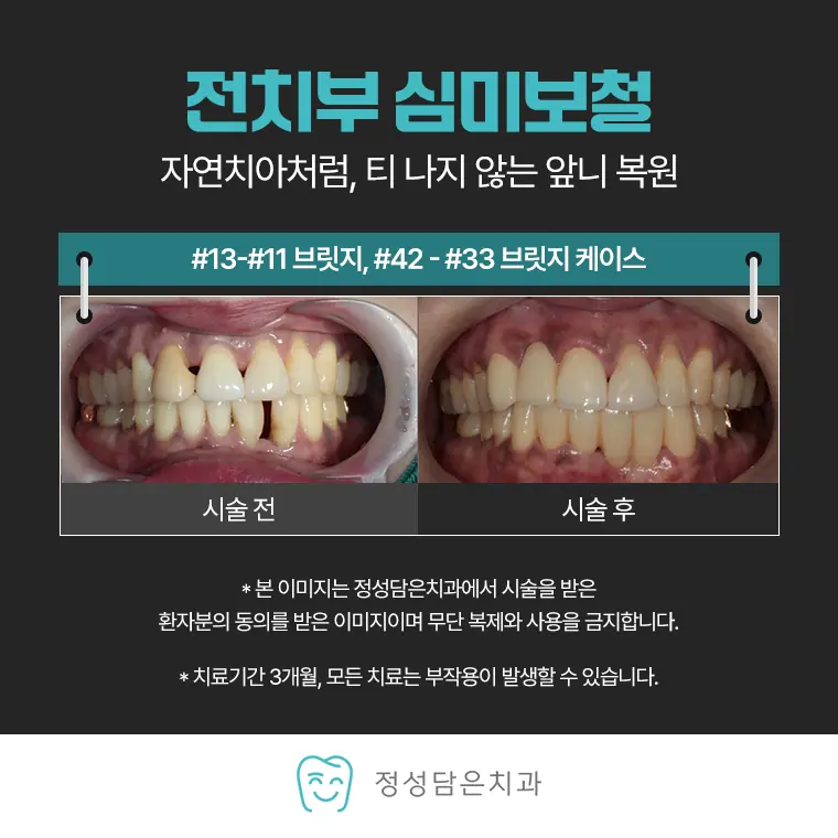 정성담은치과 전치부 심미보철 케이스