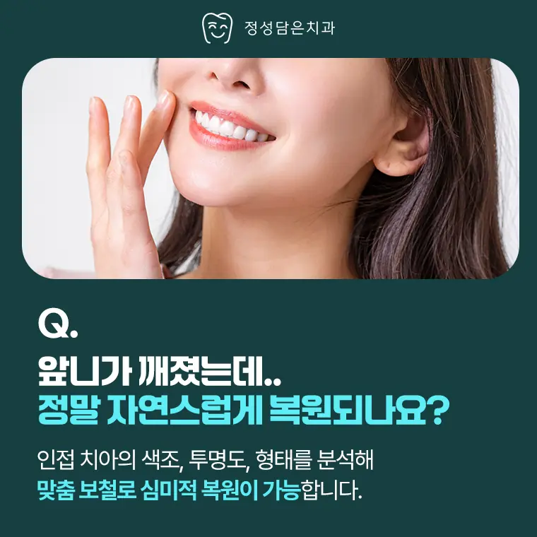 정성담은치과 앞니가 깨졌는데 정말 자연스럽게 복원되나요?