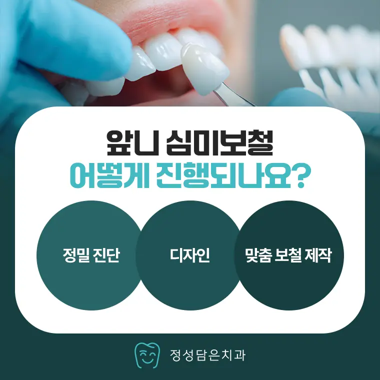 정성담은치과 앞니 심미보철 어떻게 진행되나요?