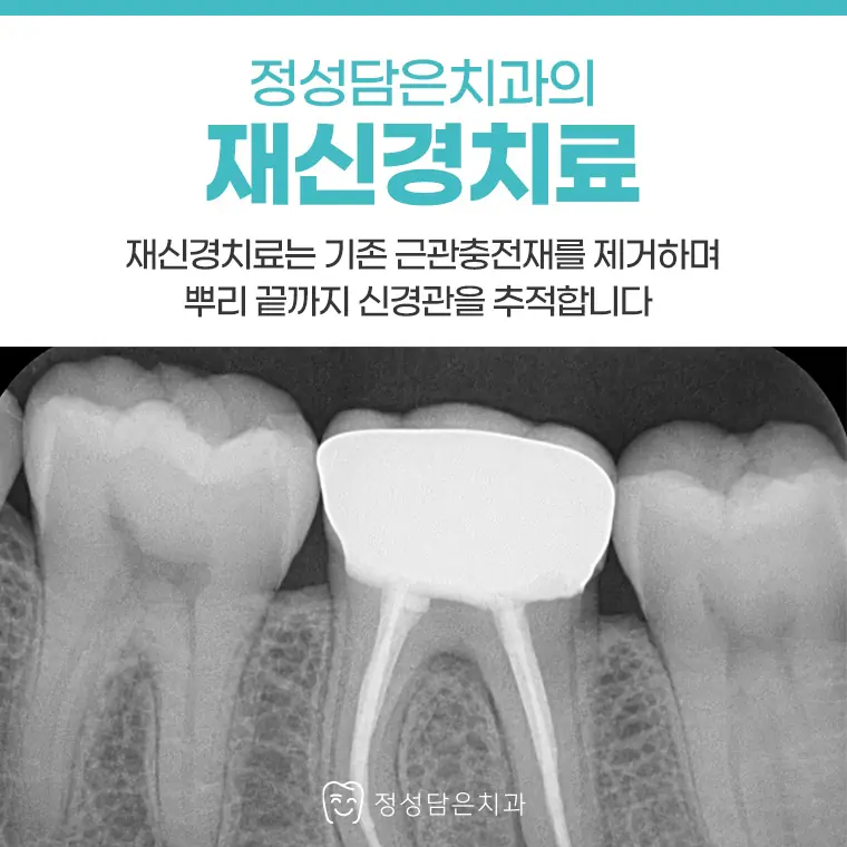 정성담은치과 재신경치료 케이스