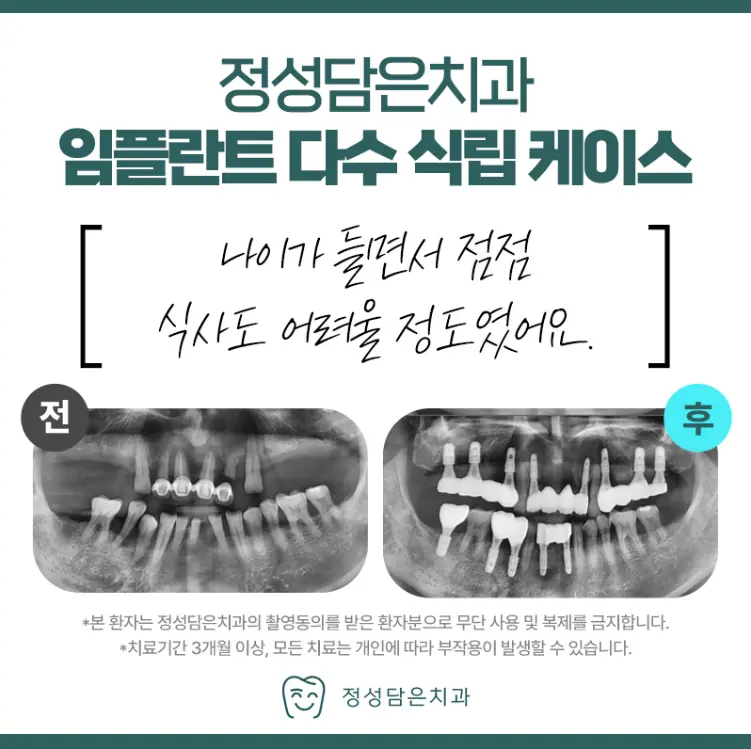 정성담은치과 임플란트 식립 케이스
