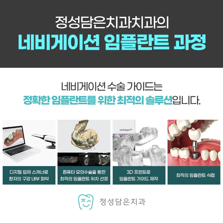 정성담은치과 네비게이션 임플란트 과정