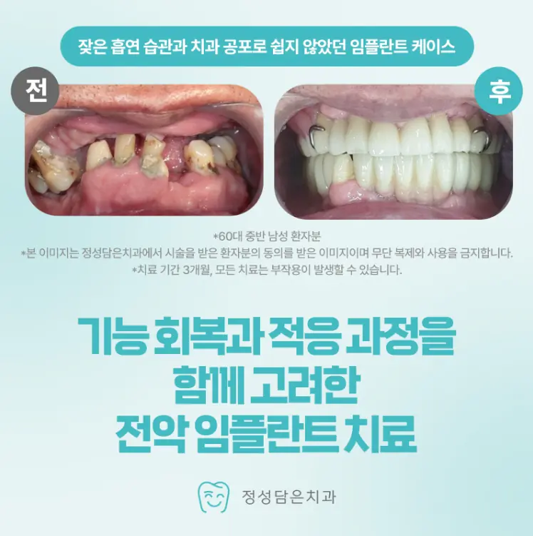 정성담은치과 임플란트 치료 케이스